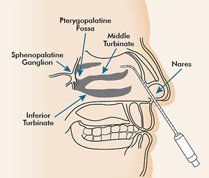 Sphenopalatine-Ganglion-2