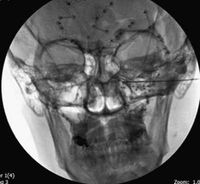 Sphenopalatine-Ganglion-3