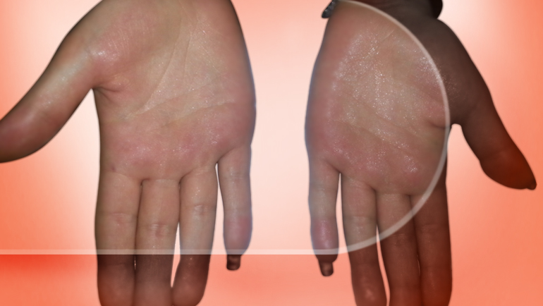 4Hyperhidrosis1