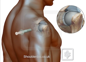 Steroid injection into subacromial space