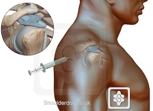Steroid injection for arthritis in bum