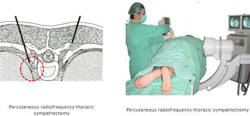 Hyperhidrosis-1