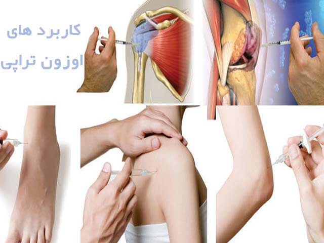 کاربردهای اوزون تراپی
