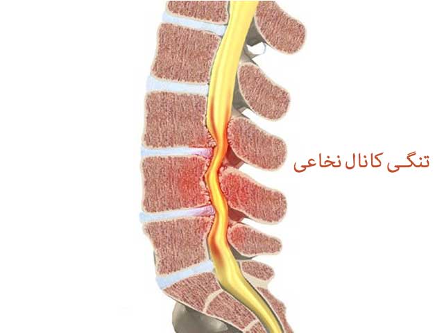 علل تنگ شدن کانال نخاع