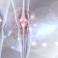 درمان آرتروز زانو با سلول درمانی