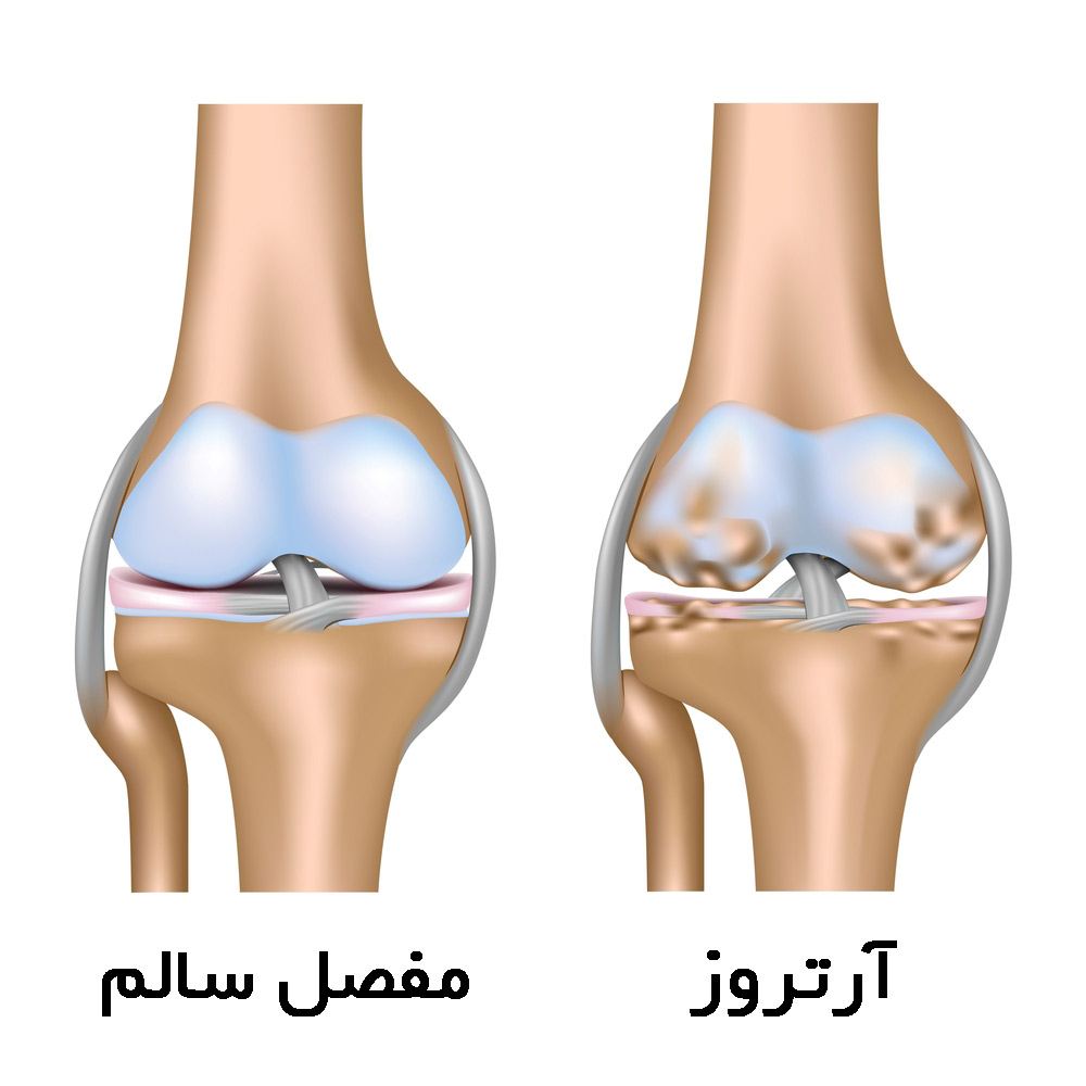 آرتروز چیست؟