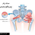 سندرم پیریفورمیس چیست؟