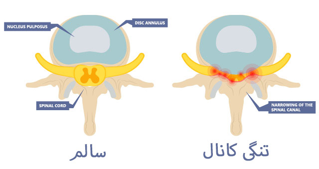 بهترین درمان های خانگی برای تنگی کانال نخاعی کمر