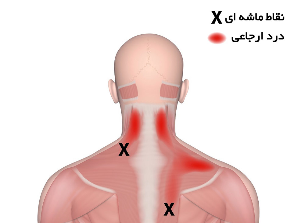 تزریق در نقاط ماشه ای