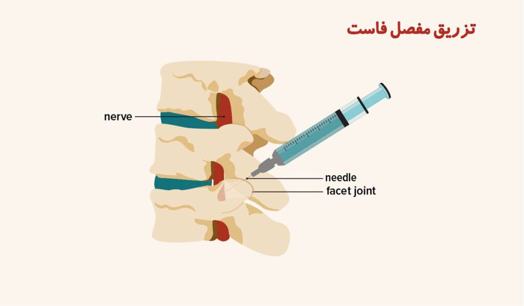 تزریق مفصل فاست برای درمان کمردرد