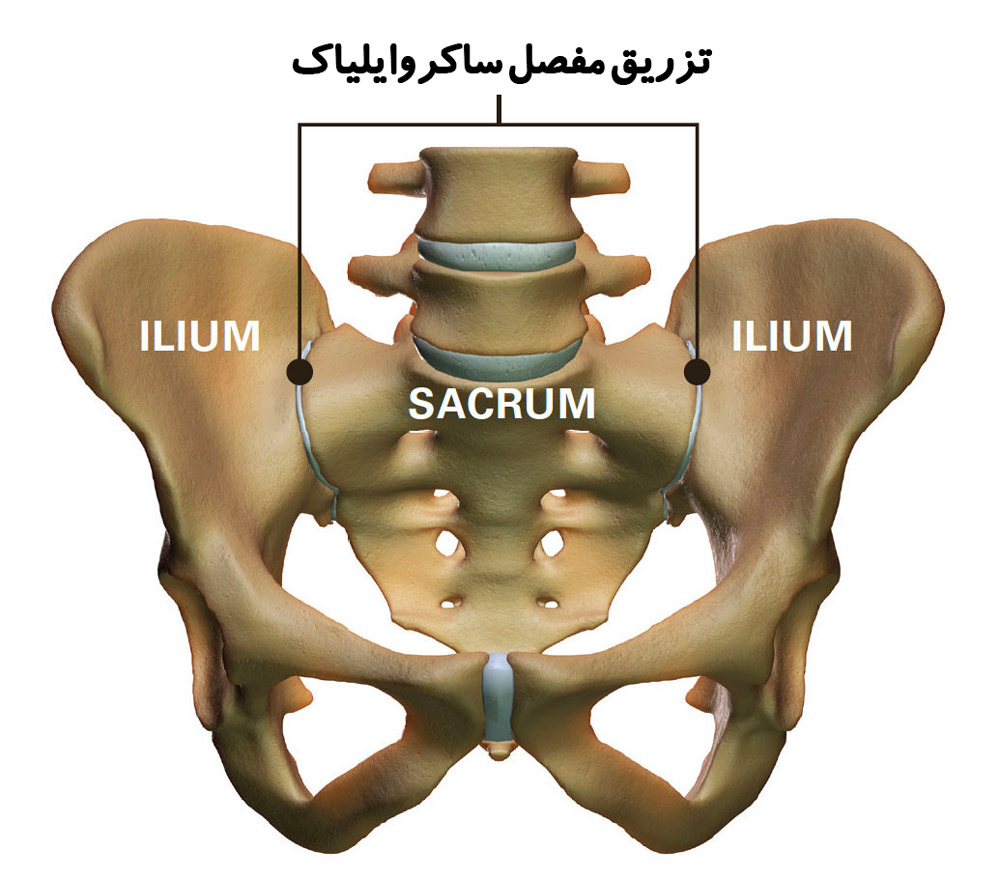 تزریق مفصل ساکروایلیاک برای تسکین کمردرد