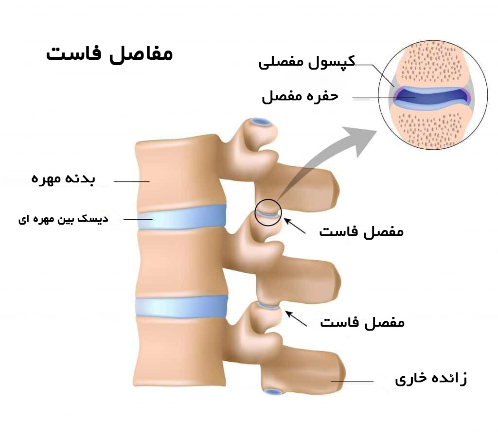 درد مفاصل فاست چیست؟