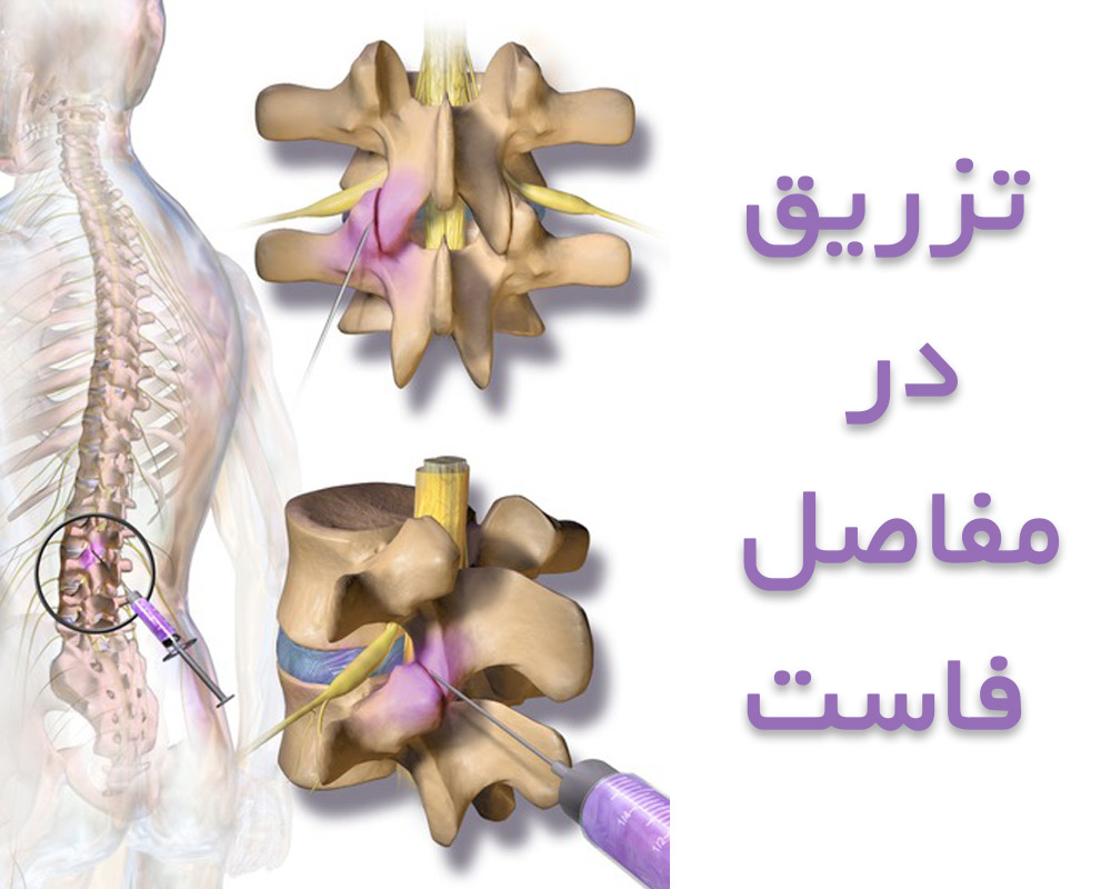 تزریق در مفاصل فاست برای تسکین دردهای کمر و گردن