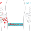 درد سیاتیک لگن چه دلایلی دارد و چگونه درمان میشود؟