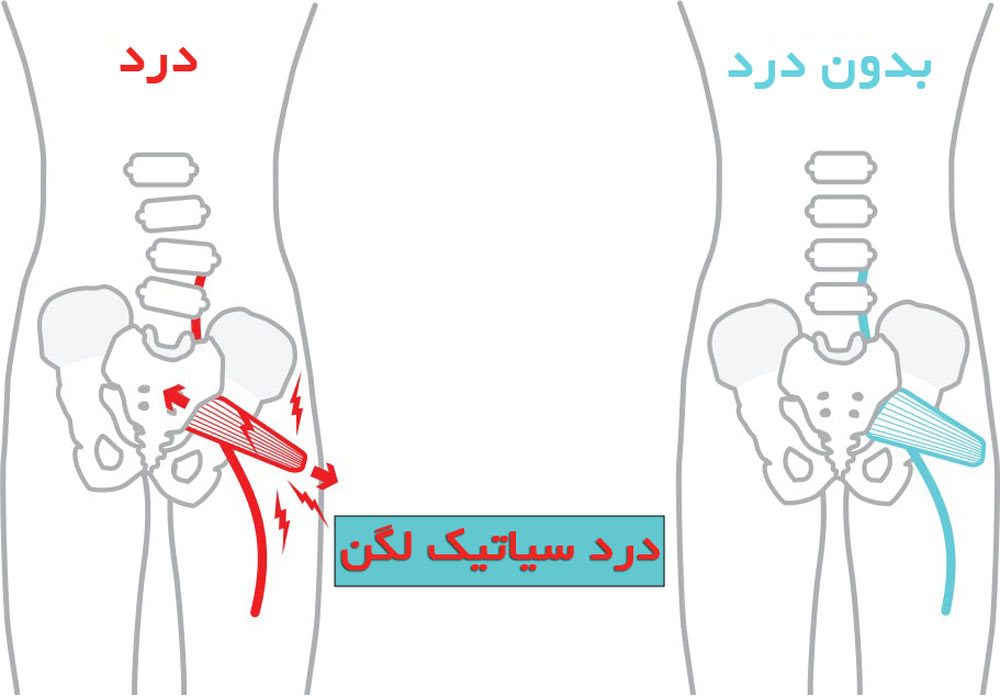 درد سیاتیک لگن چه دلایلی دارد و چگونه درمان میشود؟