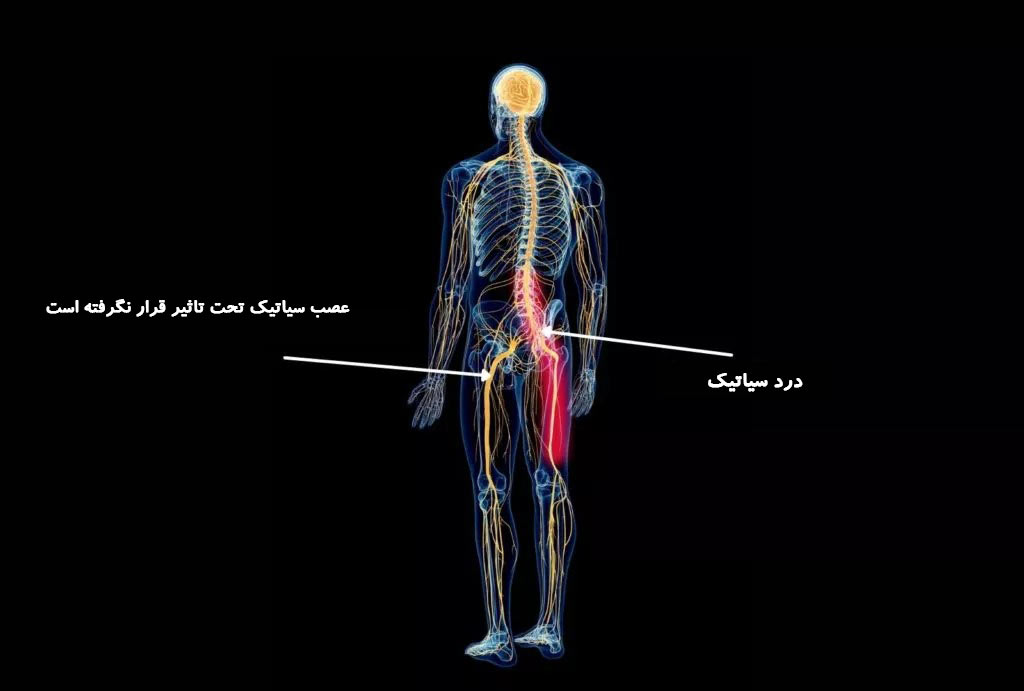 آیا پیاده روی می تواند درد سیاتیک را تسکین دهد؟