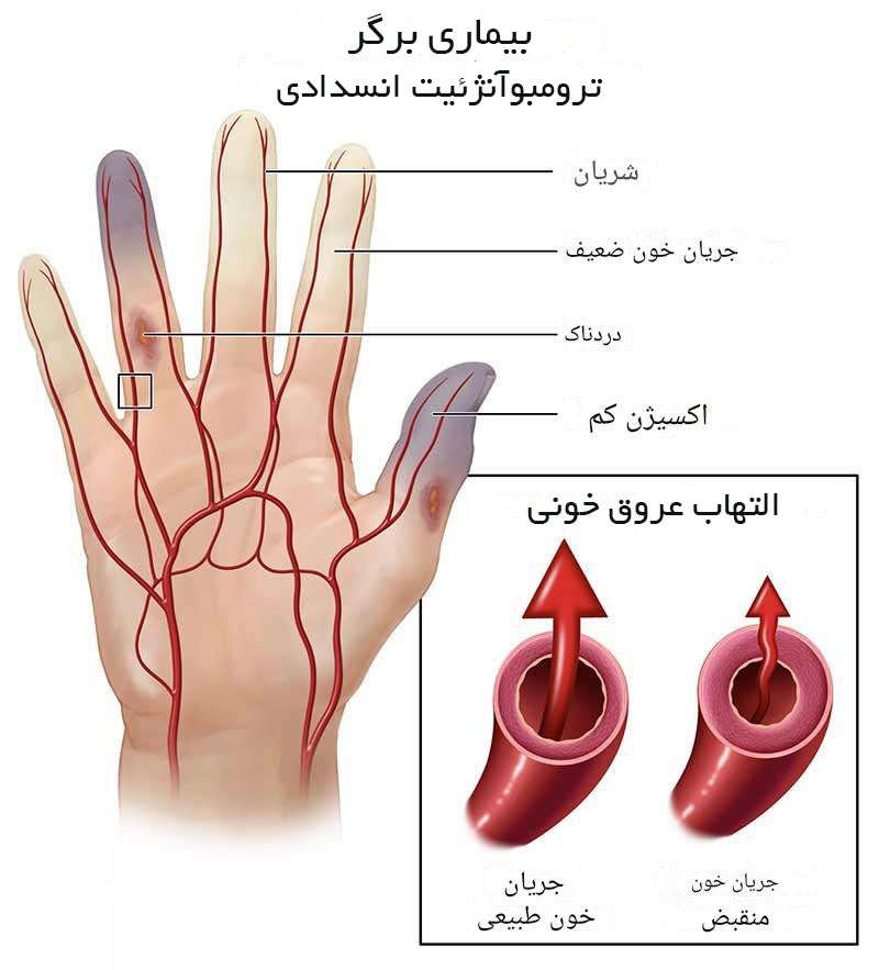 بیماری برگر یا ترومبوآنژئیت انسدادیچیست؟
