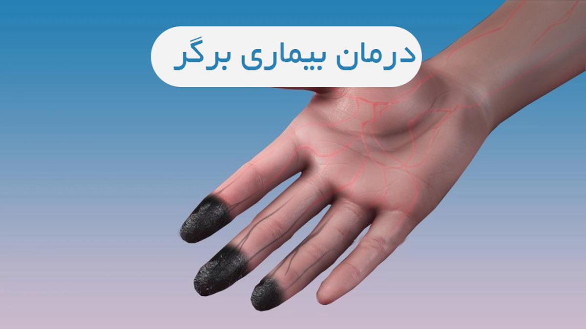 درمان بیماری برگر