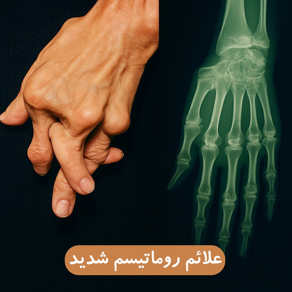 علائم روماتیسم شدید و نهایی چیست و چه درمانی دارد؟