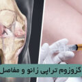 اگزوزوم تراپی زانو