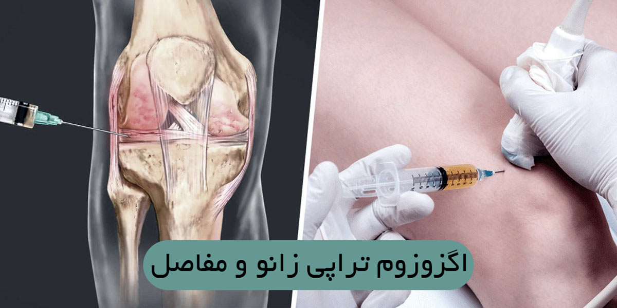اگزوزوم تراپی زانو