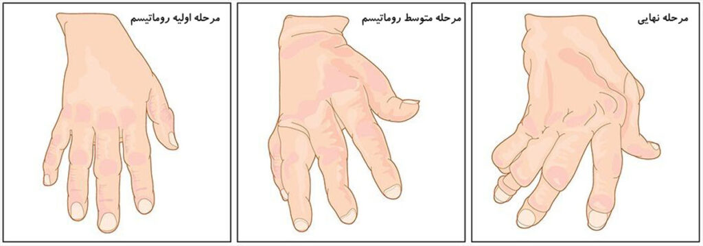 مراحل بیماری روماتیسم مفصلی