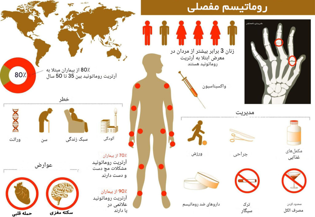 روماتیسم مفصلی