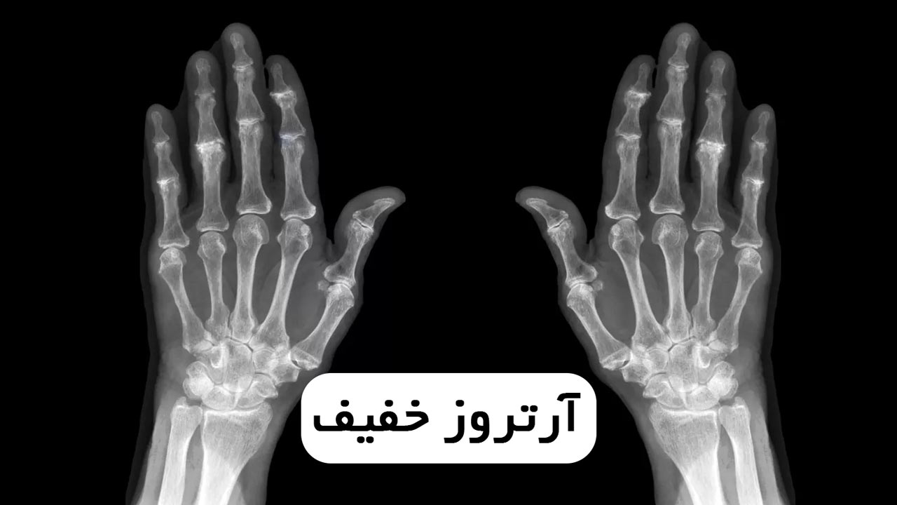 آرتروز خفیف