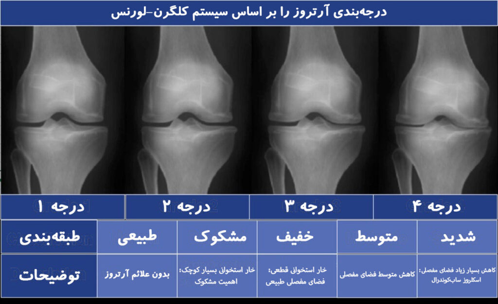 دسته بندی و مراحل آرتروز با سیستم کلاسیفیکیشن کلگرن-لورنس