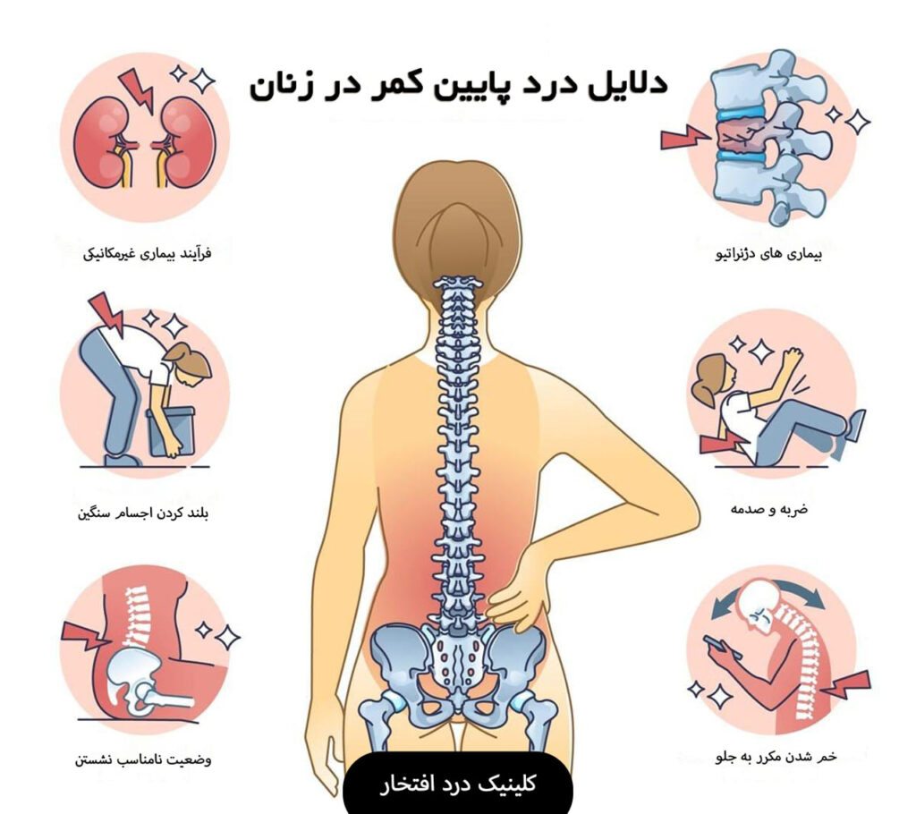 علل درد پایین کمر در زنان
