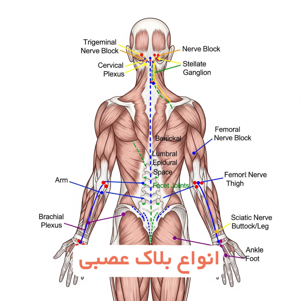 انواع بلاک عصبی