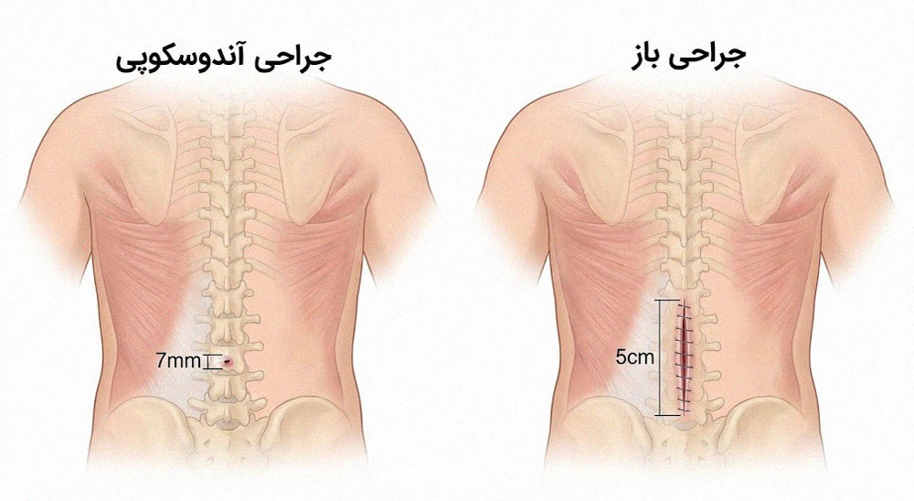 مقایسه اندازه برش جراحی آندوسکوپی دیسک کمر با جراحی باز ستون فقرات