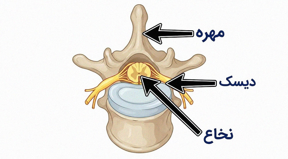 فشردگی نخاعی