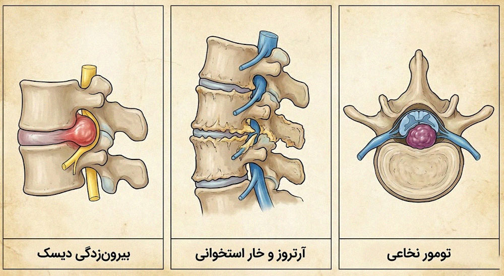 دلایل فشردگی نخاعی