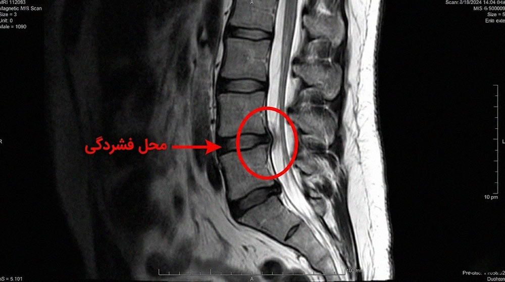 تصویر ام آر آی ستون فقرات نشان دهنده محل دقیق فشردگی نخاع