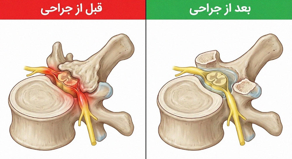 تصویر پزشکی قبل و بعد از عمل جراحی لامینکتومی برای رفع فشار نخاع