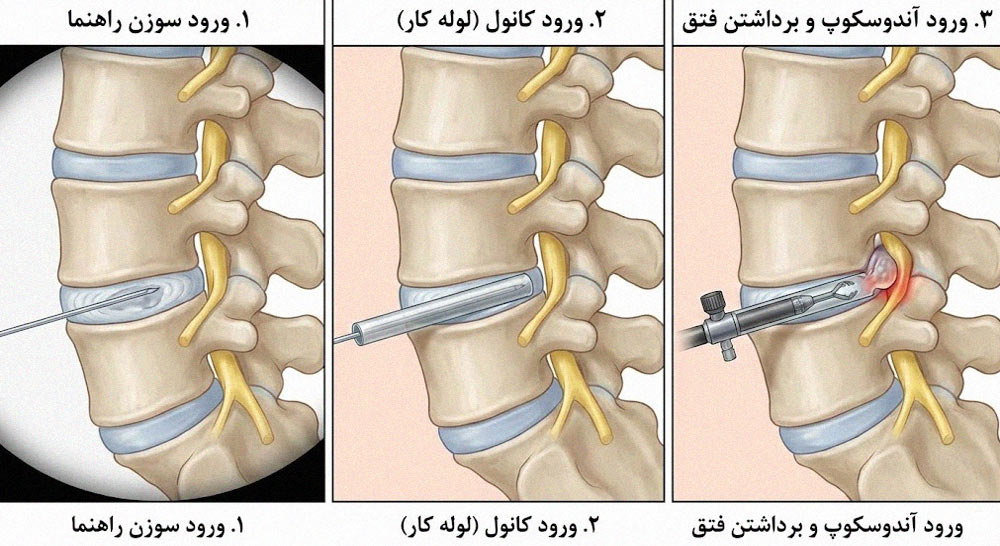 مراحل تصویری ورود کانول و آندوسکوپ به داخل دیسک کمر
