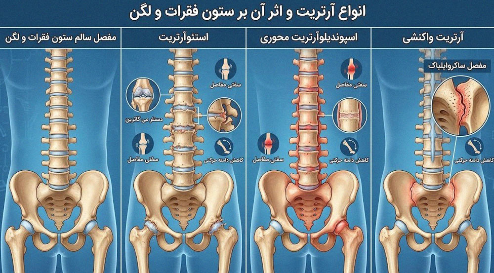 انواع آرتریت و نحوه اثرگذاری آن ها بر ستون فقرات و لگن