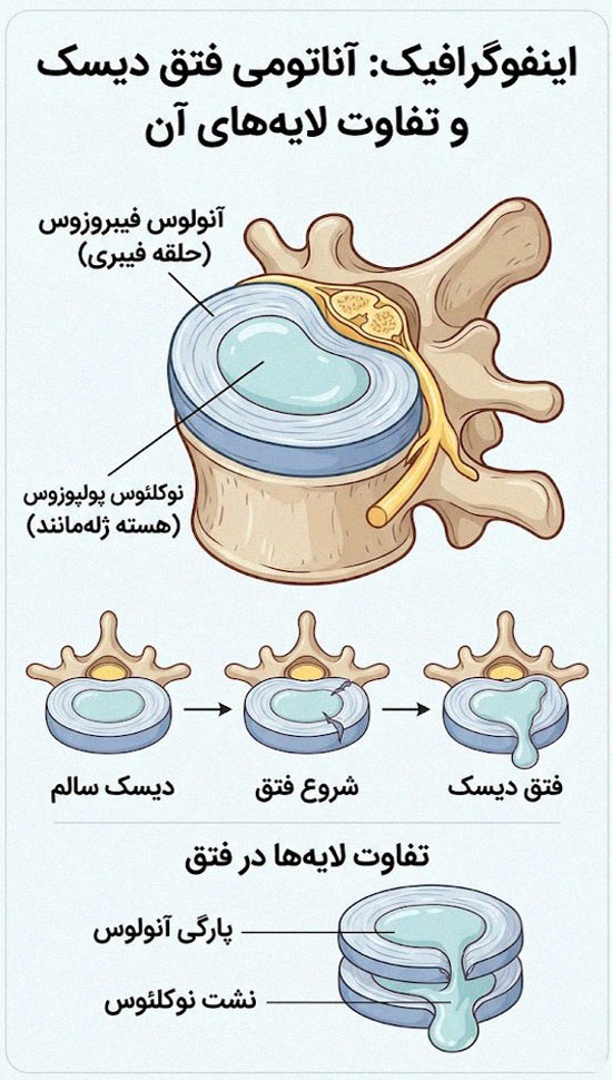 آناتومی فتق دیسک و تفاوت لایه های آن