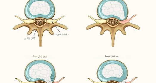 انواع دیسک کمر؛ علائم، تشخیص و درمان