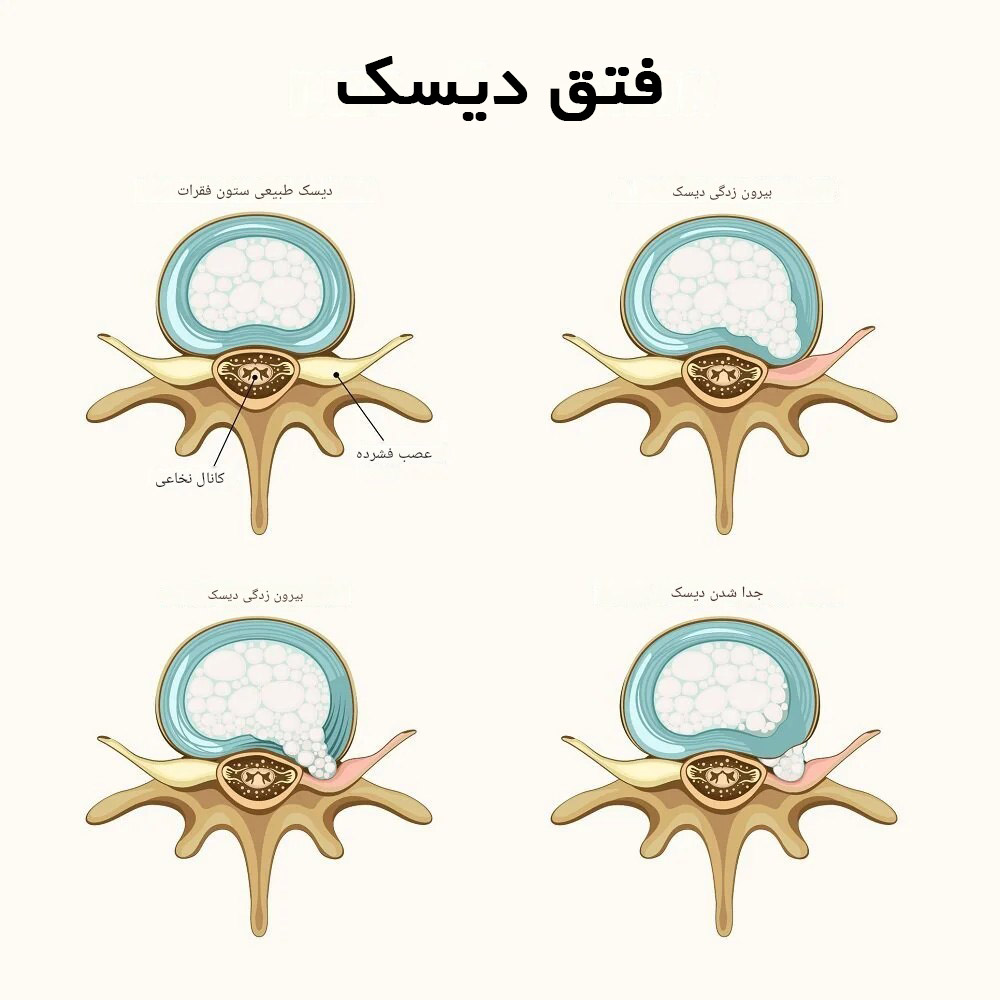 انواع دیسک کمر؛ علائم، تشخیص و درمان