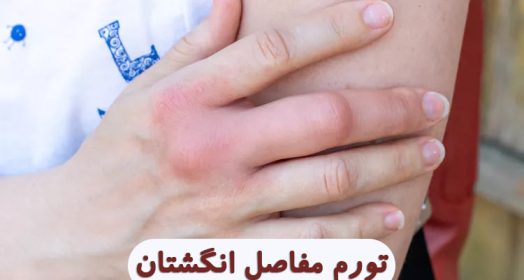 ورم مفاصل انگشتان