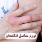 swollen finger joints causes treatment 85x85