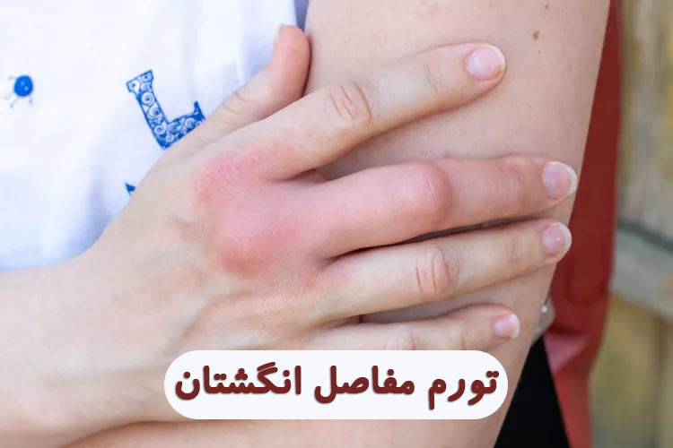 ورم مفاصل انگشتان