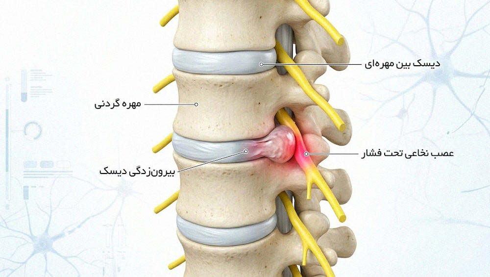 بیرون زدگی دیسک گردنی و تأثیر آن بر اعصاب نخاعی