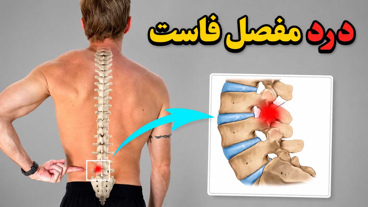 سندرم و درد مفصل فاست