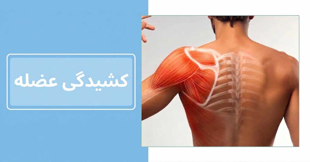 کشیدگی عضله چیست