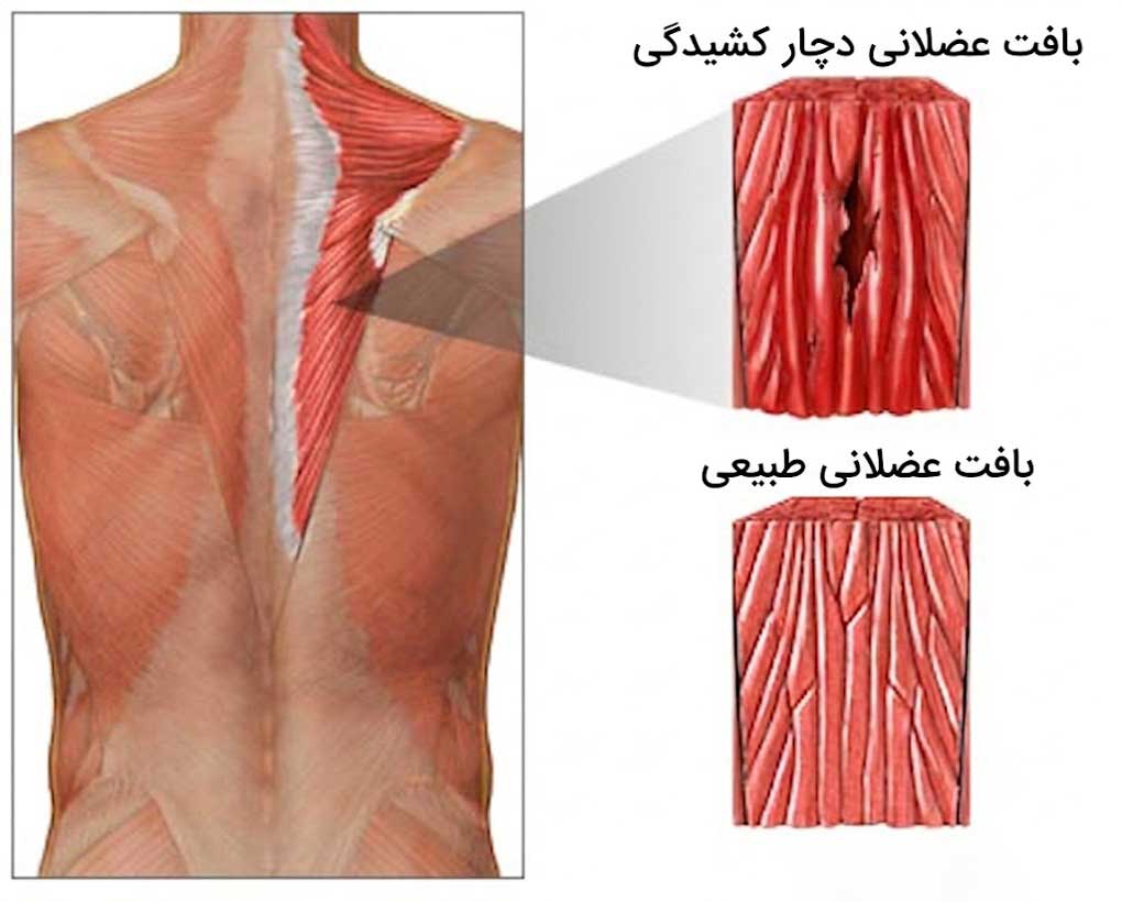 کشیدگی عضله