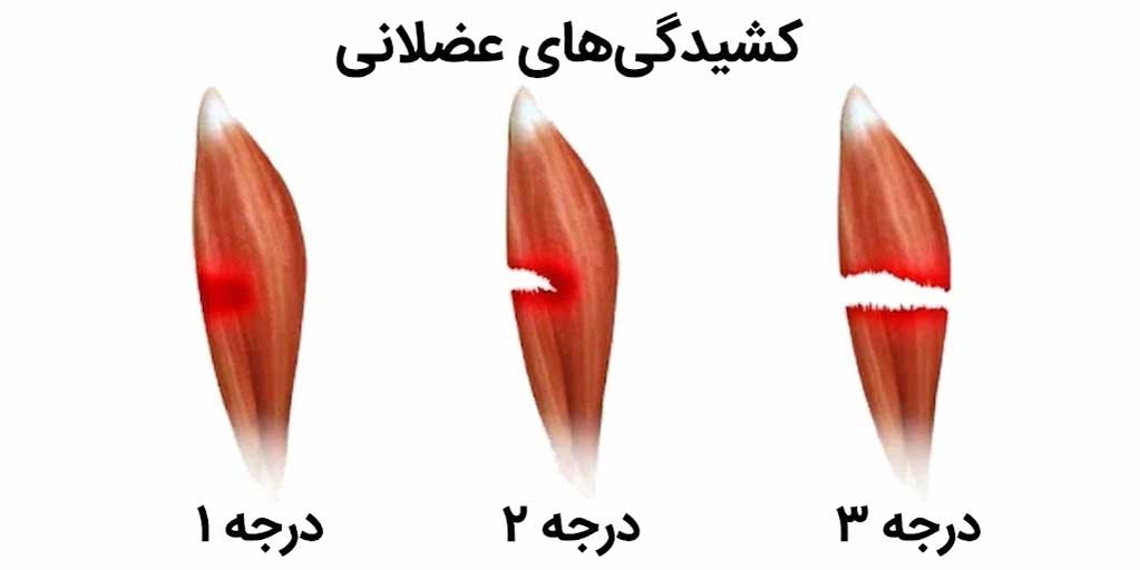 درجه‌بندی شدت آسیب عضلانی