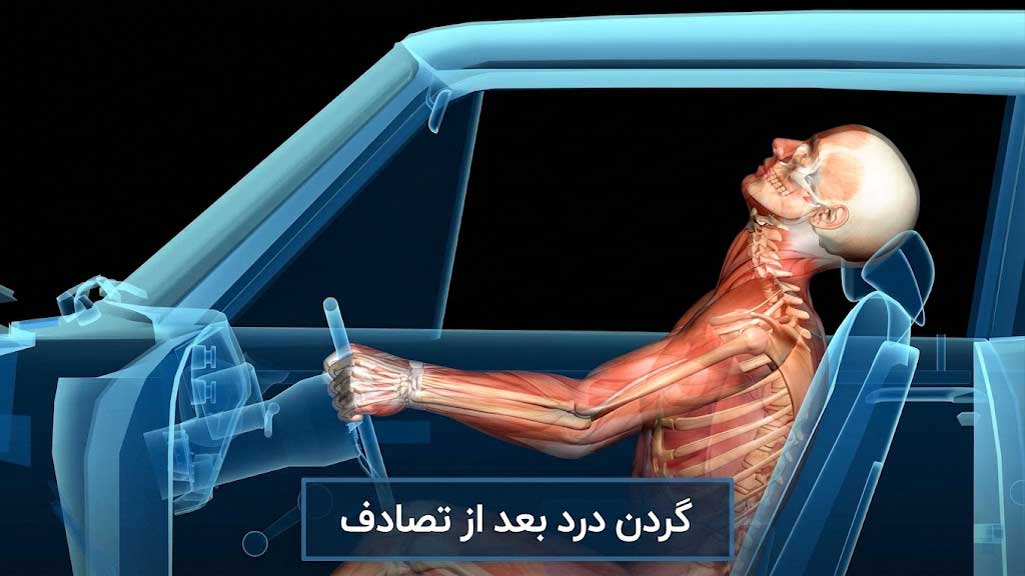 گردن درد بعد تصادف